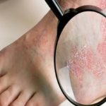¿Que tratamientos existen para la Psoriasis?