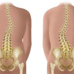 ¿Qué es la escoliosis lumbar?