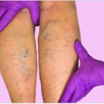 Tengo Varices ¿qué puedo hacer?