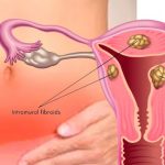 5 cosas que deberías saber del Mioma uterino