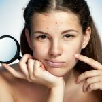 ¿Cómo combatir el acné juvenil?