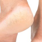 3 tratamientos naturales hidratantes para suavizar la piel de los talones