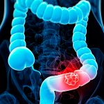 Cáncer de colon, cómo prevenirlo
