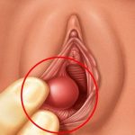 ¿Qué significa una bolita en la región genital que duele mucho?