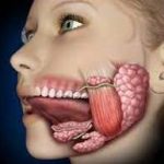 Cálculo salival (Sialolitiasis); Causas y síntomas.