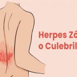 La “culebrilla” Qué es y cómo se trata.