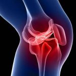 ¿Qué es la artrosis y cómo evitarla? Nuevas oportunidades para tratarla