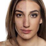 El acné en la mujer adulta: opciones de tratamiento