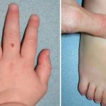 ¿Qué es la artritis psoriásica?