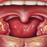 ¿Qué son las piedras de amígdalas? Síntomas, Causas, Diagnóstico, Tratamiento y Prevención