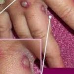 Viruela del mono: cómo se trasmite, cuáles son los síntomas y qué hacer para evitar contagiarte
