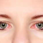 Conjuntivitis ¿soluciones naturales?