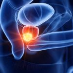 Cáncer de próstata: Los primeros síntomas que deben alertarnos