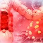 Alarma Mundial: Incrementos de cáncer en personas menores de 50 años en el mundo