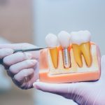 Claves para el éxito en un tratamiento de implantes dentales